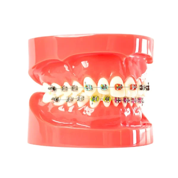 Evodent Orthodontic Model with Metal Bracket Red