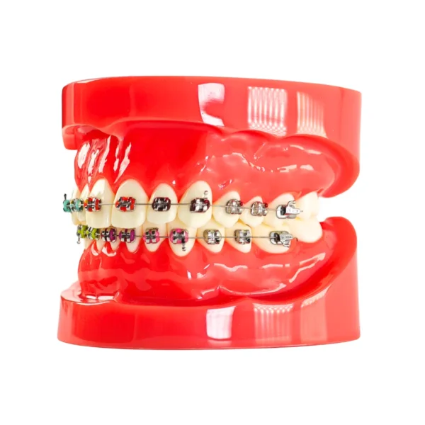 Evodent Orthodontic Model with Metal Bracket Red