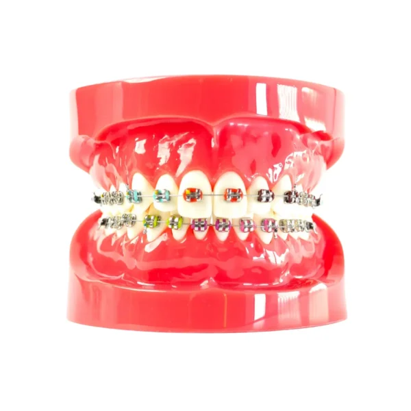 Evodent Orthodontic Model with Metal Bracket Red