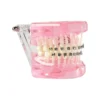 Evodent Orthodontic Model With Metal Bracket