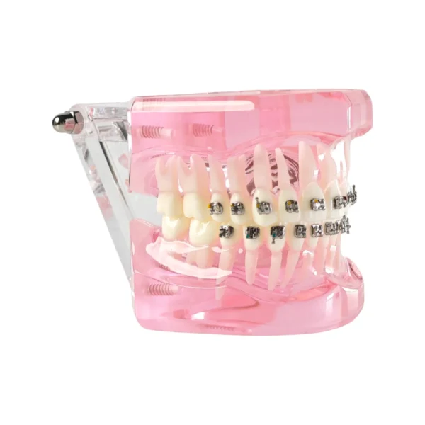 Evodent Orthodontic Model with Metal Bracket