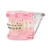 Evodent Orthodontic Model With Metal Bracket