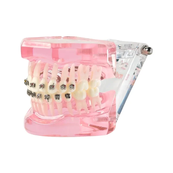Evodent Orthodontic Model with Metal Bracket
