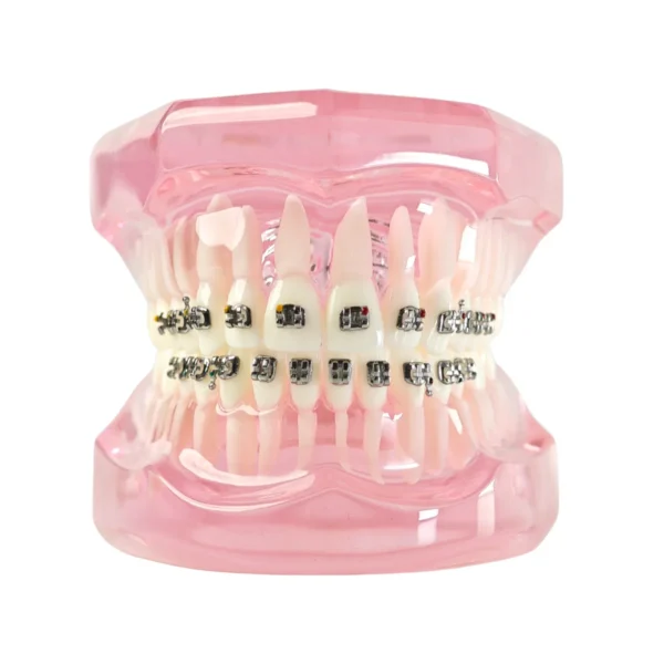 Evodent Orthodontic Model with Metal Bracket