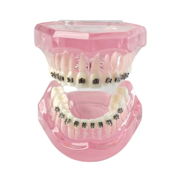 Evodent Orthodontic Model with Metal Bracket