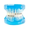 Evodent Orthodontic Model With Metal, Ceramic And Lingual Bracket Clear