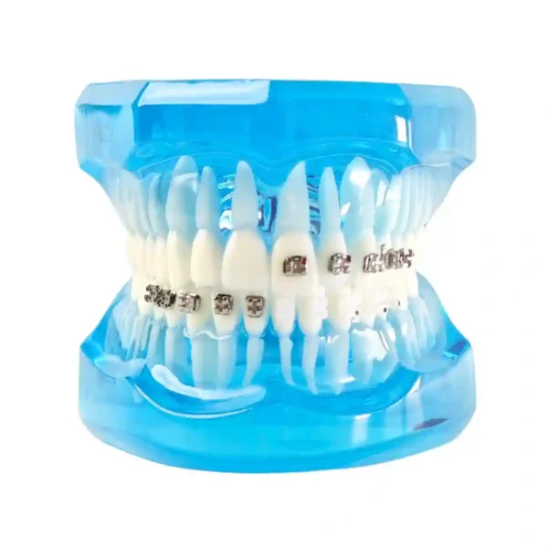 Evodent Orthodontic Model with Metal, Ceramic and Lingual Bracket Clear