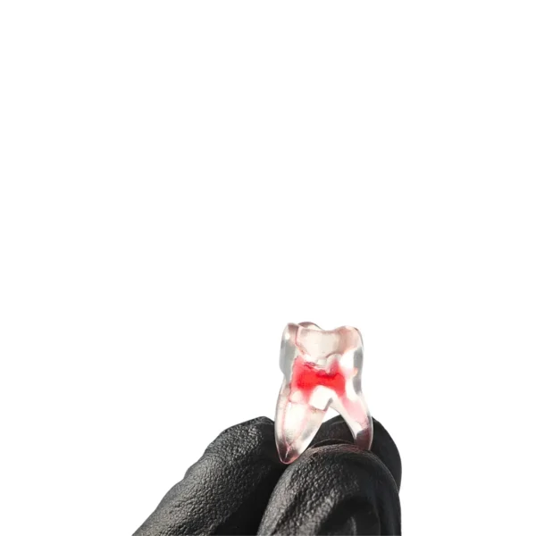 Evodent Tooth with Pulp Chamber and Cavity Filling, Molar
