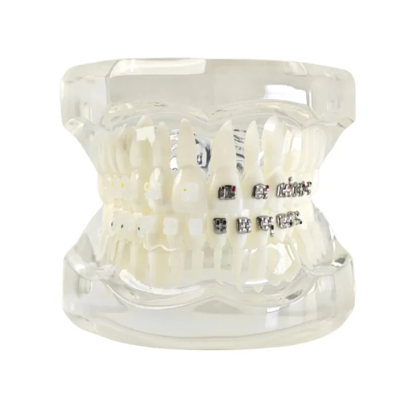 Evodent Orthodontic Model with Metal and Ceramic Bracket