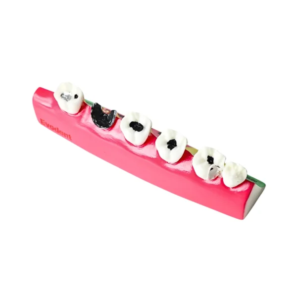 Evodent Tooth Decay & Caries Progression Model