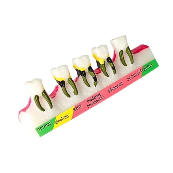 Evodent Periodontal Disease Progression Model, Patient Education