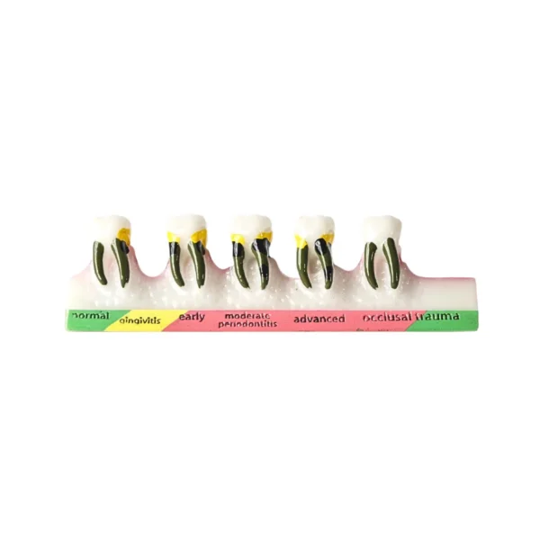 Evodent Periodontal Disease Progression Model, Patient Education